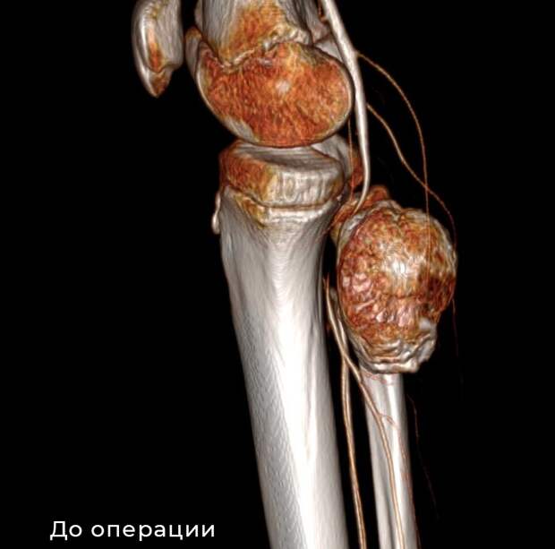 Самарские врачи удалили массивный костный нарост школьнику из Оренбурга