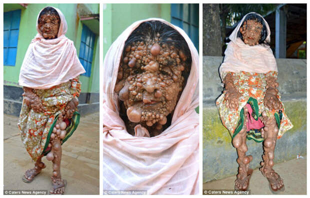 Женщина с сотнями опухолей мечтает умереть бангладеш, болезнь, опухоль