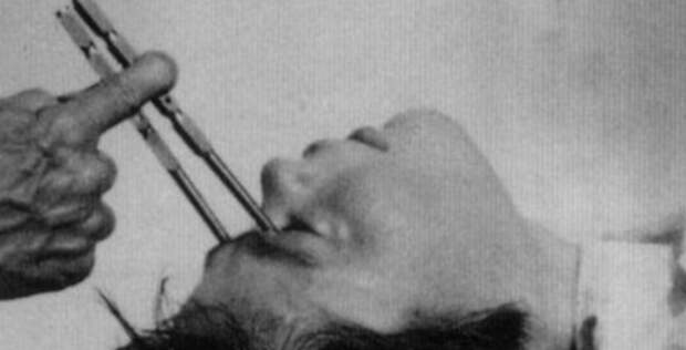 Бедлам, лоботомия и цепи: жуткая история психиатрии 22