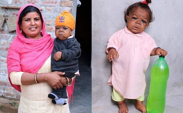 Взрослый индиец с телом шестимесячного младенца