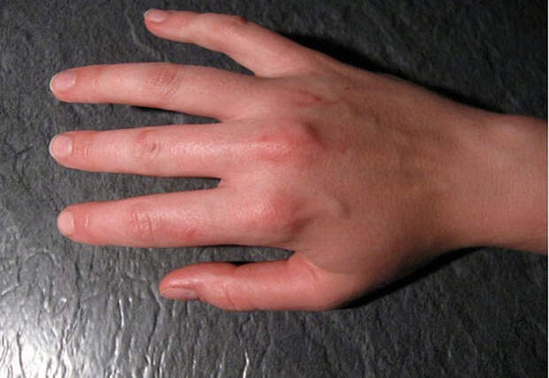 ревматическое поражение суставов пальцев рук