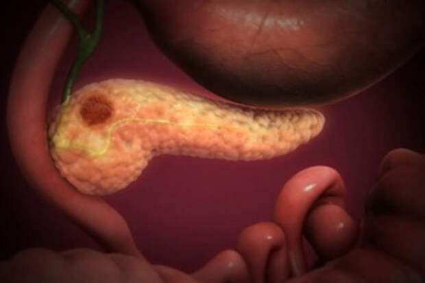 GER: предраковые клетки поджелудочной создают "убежище" от иммунной системы