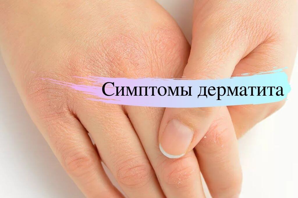 Фото отзыв лечения дерматита Что такое атопический дерматит и можно ли хоть как-то решить эту проблему - Обсу