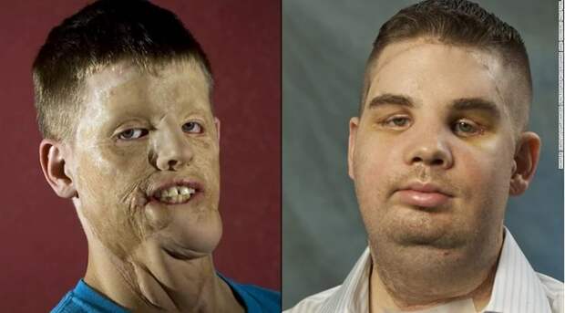 Это напоминает историю о трансплантации другого человека - Митчелла Хантера. Спустя пять лет после операции он выглядит отлично. лицо, медицина, трансплантация