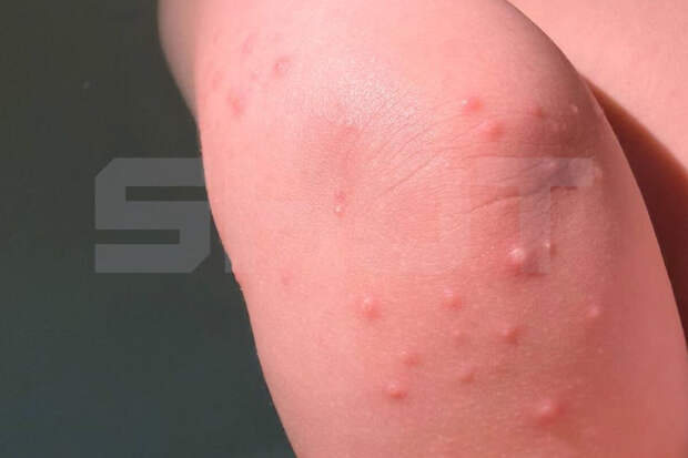 SHOT: у детей из России на курорте Таиланда появилась сильная сыпь и температура