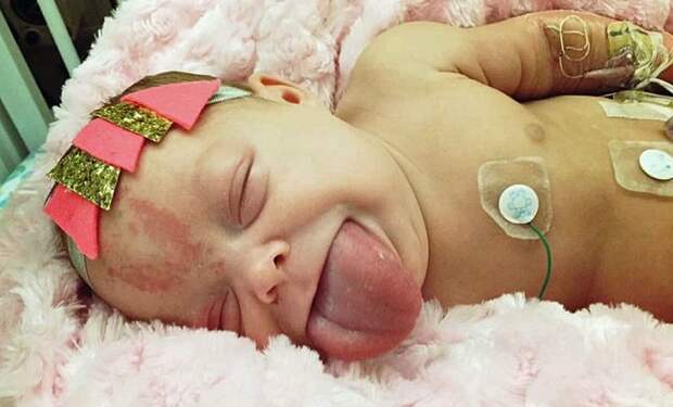 Малышка, родившаяся с огромным языком, наконец-то может улыбаться девочка, ребенок, синдром, язык