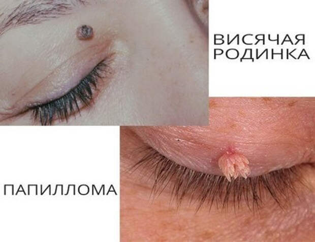 Чем отличаются родинки от папиллом и бородавок