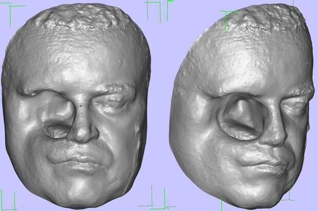 Этому мужчине сделали протез лица при помощи смартфона и 3D-принтера!