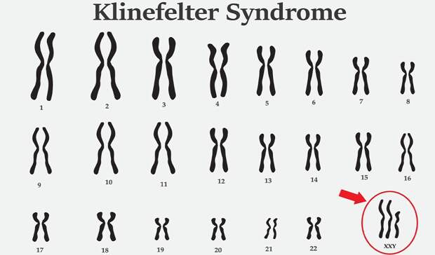 Подтверждён древнейший случай синдрома Клайнфельтера.
