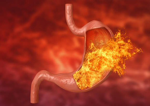 Изжога не всегда говорит о повышенной кислотности!