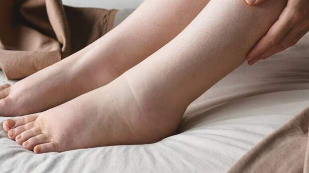 Почему появляются отеки: что скрывает задержка жидкости в организме