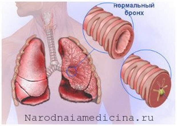 Острый бронхит