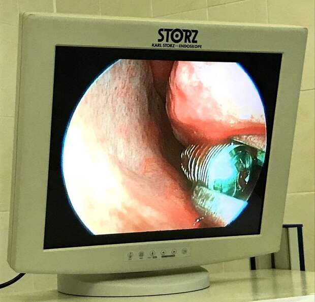 Нижегородские врачи извлекли зубной имплант из носа пациента
