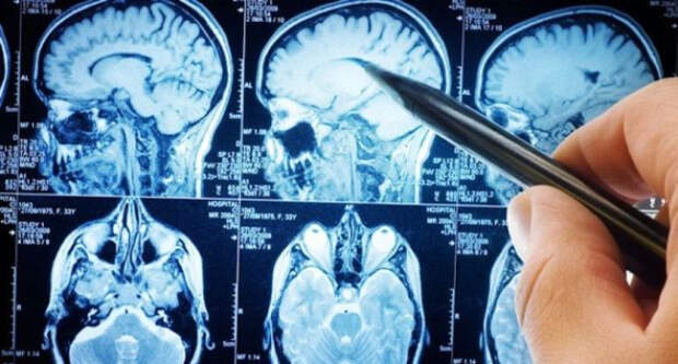В России создали краситель для визуализации опухоли головного мозга при операции