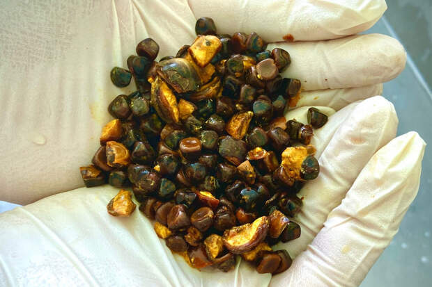 SHOT: россияне зарабатывают до 100 тыс. рублей на продаже желчных камней