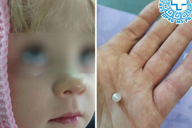 В Бурятии врачи спасли зрение ребенку, затолкавшему в глаз бусину