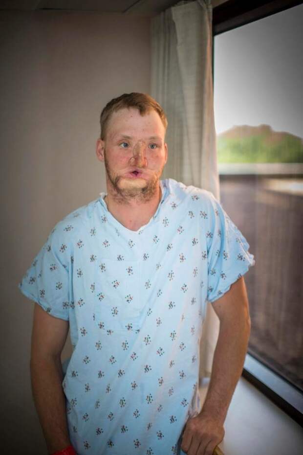 Невероятные результаты пересадки лица, сделанной парню после того, как он выстрелил себе в лицо лицо, люди, медицина, операция