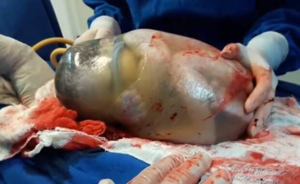 Bebê Nasce De Parto Empelicado E Vídeo Do Nascimento Viraliza