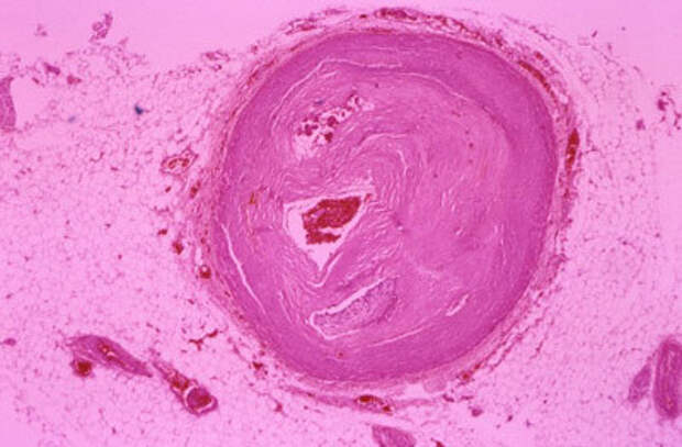 Как стресс закупоривает артерии