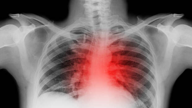 Врач Евдокимов: слишком плотный приём пищи может спровоцировать сердечный приступ