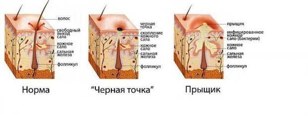 Откуда берутся прыщи? Психосоматика