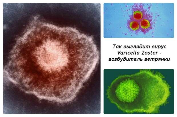 Вирус Herpesviridae (Varicella Zoster)