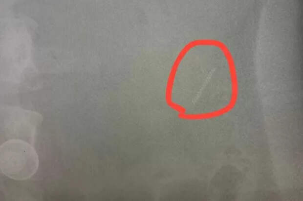 Жительница Подмосковья проглотила пружину от брекет-системы во время обеда