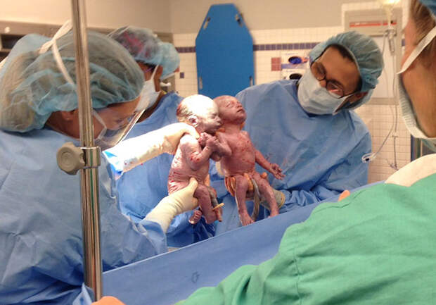 identical-twins-born-holding-hands-jenna-jillian-sarah-thistlethwaite-19