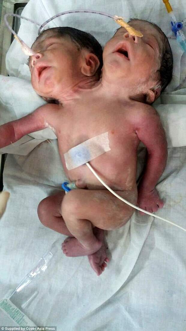 Ребенок в Индии, родившийся с двумя головами, прожил всего 32 часа после родов аномалия, дети, индия, ужас