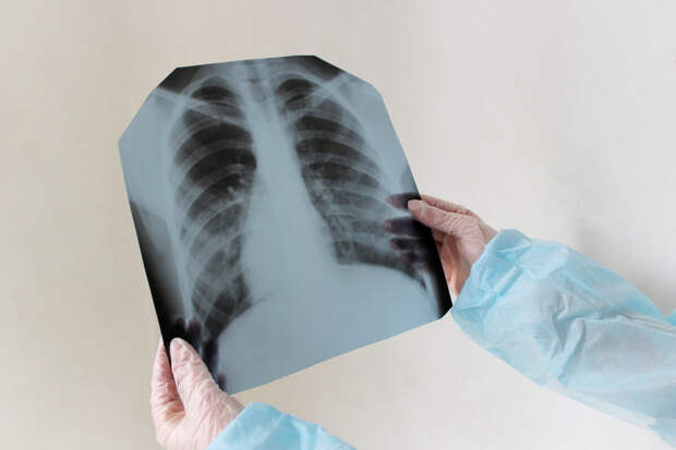 NatCom: найден иммунный механизм, контролирующий "спящий" туберкулез