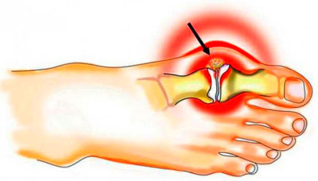 Артрит большого пальца ноги