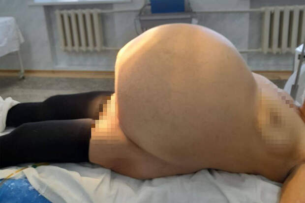 В Башкирии медики удалили женщине опухоль яичника объемом 30 литров