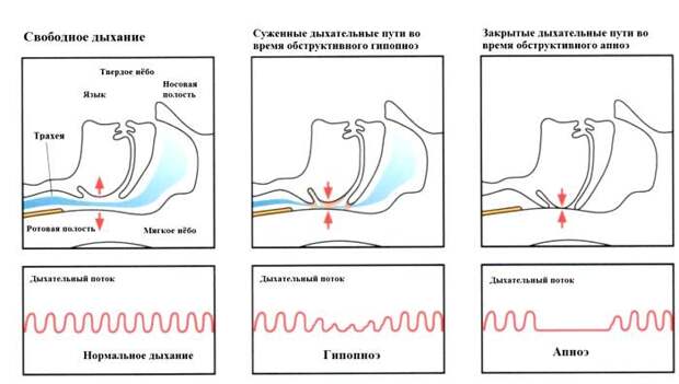 причины храпа