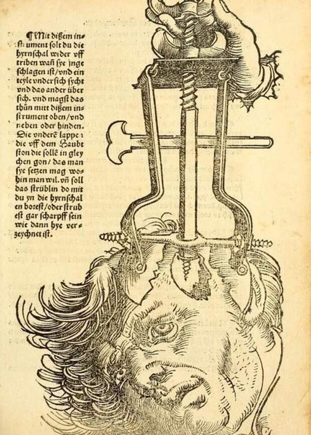 Нейрохирургия 1530 год