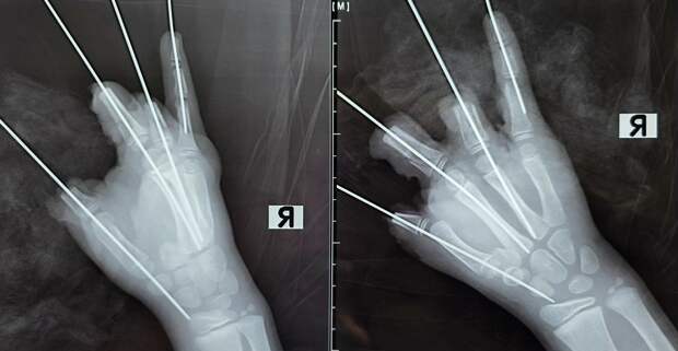 В Петербурге ребенку ампутировали четыре пальца после прогулки с петардой