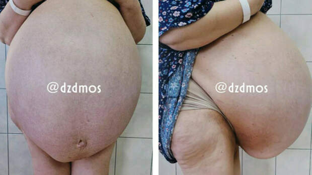 Опухоль / Фото: Официальные новости Московской медицины