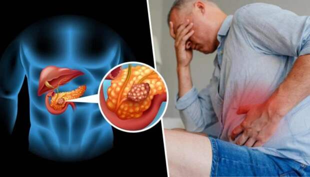 Революционное тройное лечение: окончательная победа над раком поджелудочной!