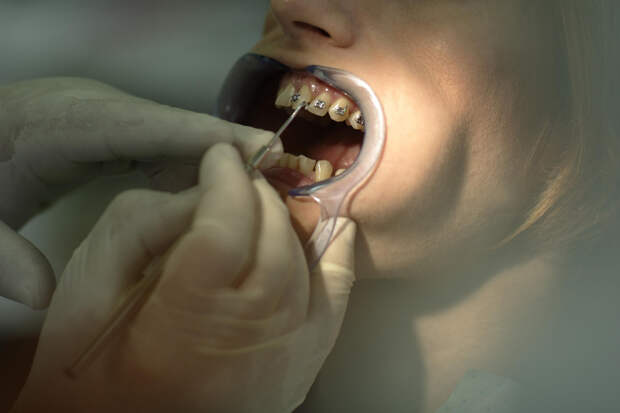 Врач предупредила о последствиях неправильно установленных брекетов