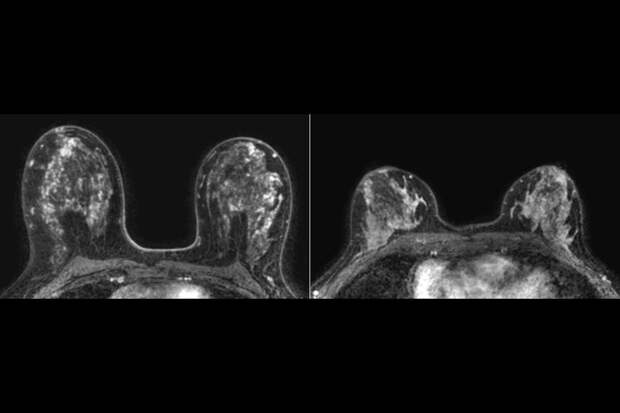 Cell: бактерия полости рта F. nucleatum может запускать развитие рака груди
