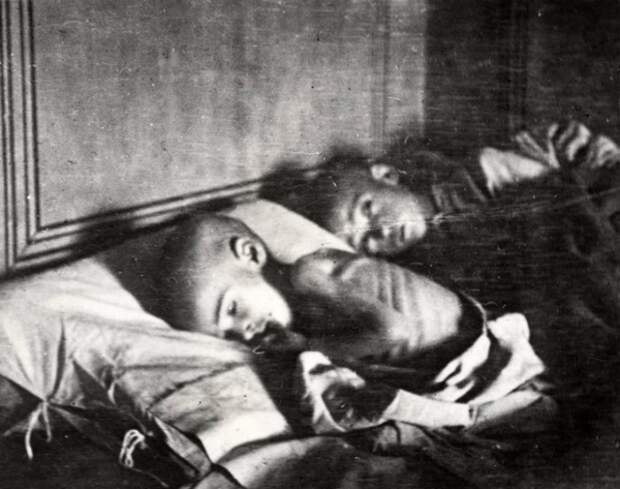 Тяжёлые последствия длительного голода. Россия, Поволжье, 1921 год.