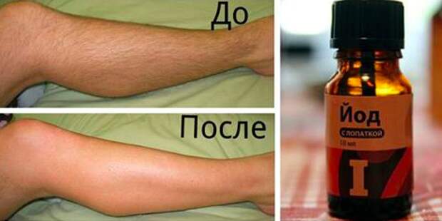 Как с помощью йода избавиться от нежелательных волос на теле: 2 рецепта