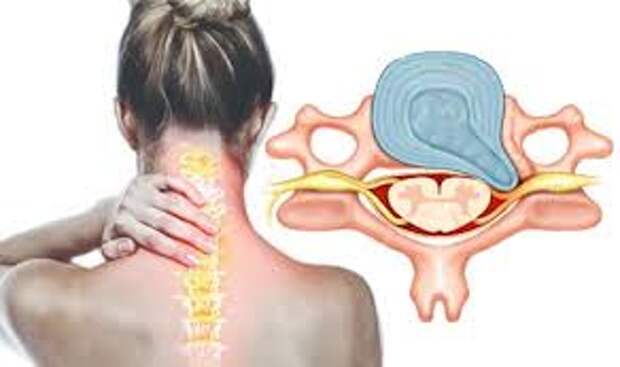 Лечение боли при протрузии межпозвонковых дисков в Тюмени 