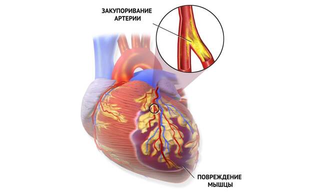 Сердечный приступ