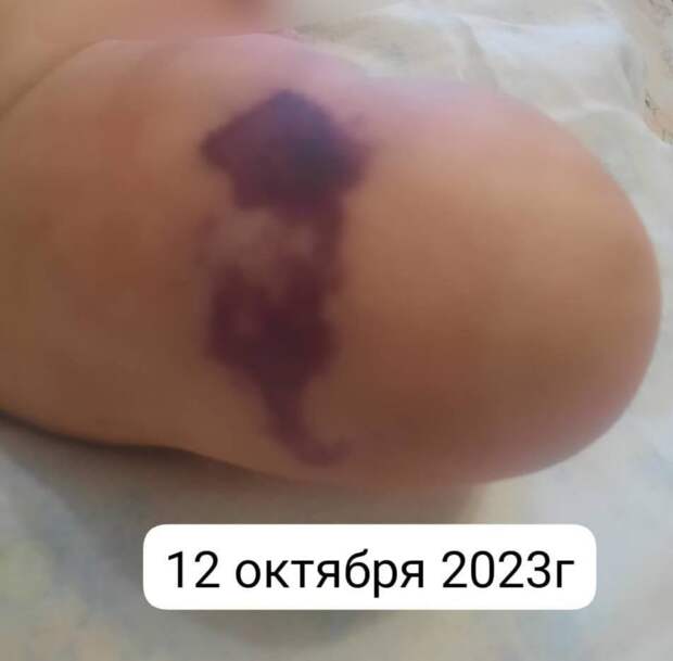 Жительница Якутска рассказала в социальных сетях о развитии некроза кожи правого бедра у ее восьмимесячного ребенка после вакцинации препаратом «Пентаксим».  Сообщается, что после прививки у ребенка поднялась температура до 39,2 ℃ и появилось покраснение в месте укола. Пришедший на вызов педиатр якобы порекомендовал делать йодную сетку. Через 3 дня кожа на ноге ребенка почернела, появилась, по словам матери, «опухоль с гноем». Дата постановки вакцины не уточняется. 