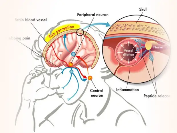 Причин утренней головной боли