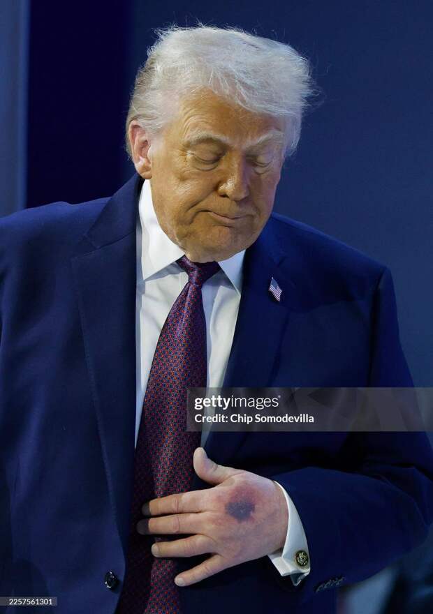 Дональд Трамп вчера в Давосе с сильными синяками на левой руке