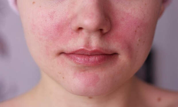 Сыпь на лице при аллергии