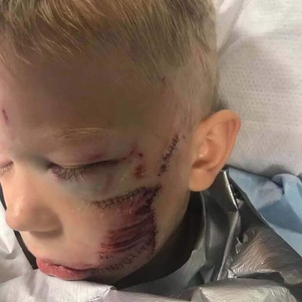 Мальчик вступился за 4-летнюю сестренку, на которую напала агрессивная собака – и получил 90 швов
