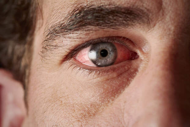 BJO: препарат для похудения повышает риск глазного инсульта