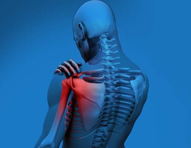 Синдром сдавления ротатора плеча, или субакромиальный импиджмент-синдром: как лечится?